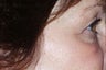 Botox