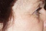 Botox