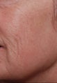 Female treated for Sunspots/Photoaging