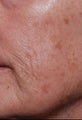 Female treated for Sunspots/Photoaging