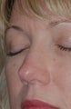 Non-Surgical Rhinoplasty
