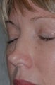Non-Surgical Rhinoplasty