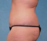 Circumferential Body Lift