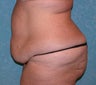 Circumferential Body Lift