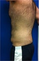 Laser Lipo