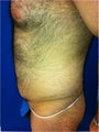 Laser Lipo