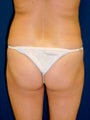 Brazilian Butt Lift