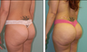 Brazilian Butt Lift Before & After