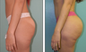 Brazilian Butt Lift Before & After