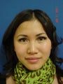 Rhinoplasty
