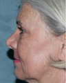 Female Patient Fraxel Repair