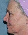 Female Patient Fraxel Repair