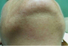 Laser Hair Removal