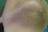 Laser Hair Removal