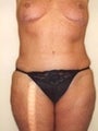 Female patient who underwent surgery for major weight loss