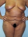 Female patient who underwent surgery for major weight loss