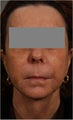 53 Year Old female with loss of cheek volume, hollowness under her eyes, nasolabial folds, and sagging jowls and neck. J