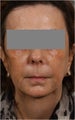 53 Year Old female with loss of cheek volume, hollowness under her eyes, nasolabial folds, and sagging jowls and neck. J