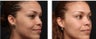 Chemical peel for improved texture and pigmentation.
