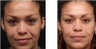 Chemical peel for improved texture and pigmentation.