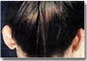 Ear Surgery (otoplasty)