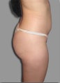 Female - Butt Augmentation
