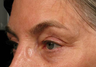 Ulthera