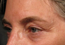 Ulthera
