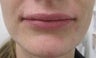 29 year-old female treated with Juvederm for thin upper lip