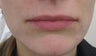 29 year-old female treated with Juvederm for thin upper lip