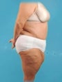 Weight Loss (Massive) & Tummy Tuck