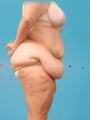 Weight Loss (Massive) & Tummy Tuck
