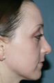 Fraxel Repair for Acne