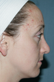Fraxel Repair for Acne