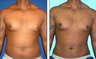 Liposuction Before & After