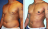 Liposuction Before & After