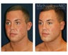 Chin Implant