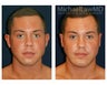 Chin Implant