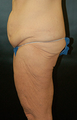 Thigh Lift/Buttock Lift