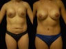 31 y/o woman with bilateral capsular contacture, saline implants and desire for tummy tuck.