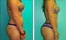 Liposuction Before & After