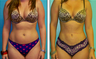 Liposuction Before & After
