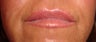 Lip augmentation