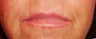 Lip augmentation