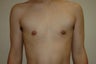 Transgender, female to male. Removal gland and nipple reduction.