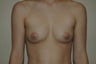 Transgender, female to male. Removal gland and nipple reduction.
