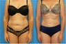 40 Year Old Female - Liposuction