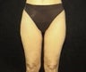 Thighplasty/Body Lift