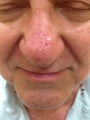 75 year old man with nasal veins treated with Ellman microneedle radio frequency