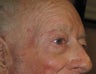 Mole/tumor removal from eyebrow using plastic surgery techniques